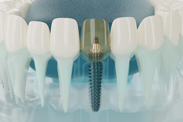 Dental Implants - Mint Leaf Dental Clinic in Markham
