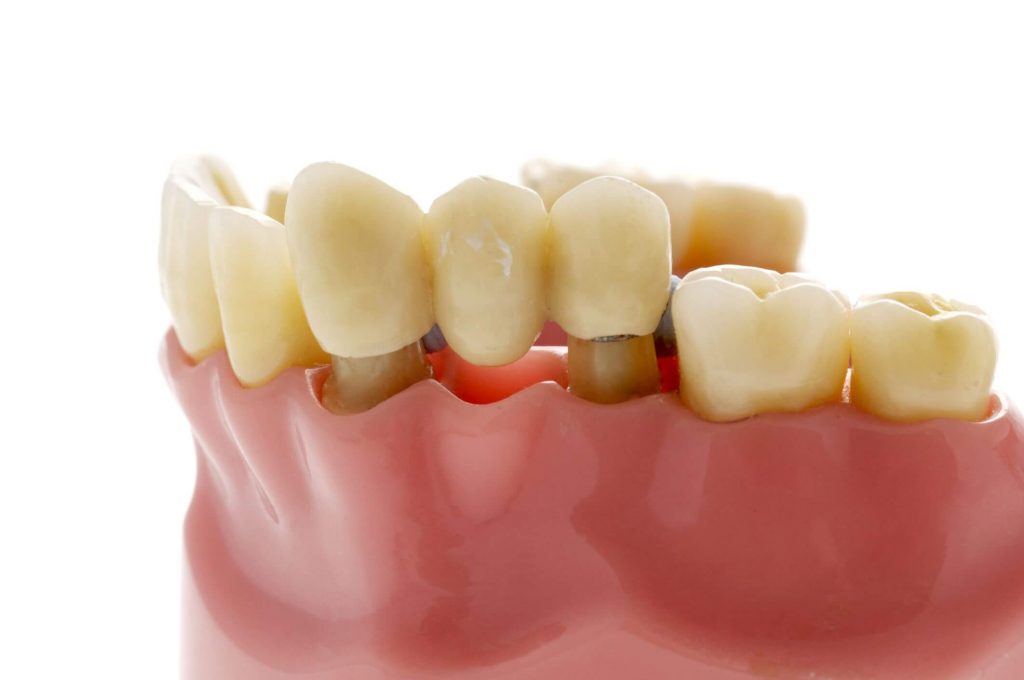 Dental Bridges- Mint Leaf Dental Clinic in Markham