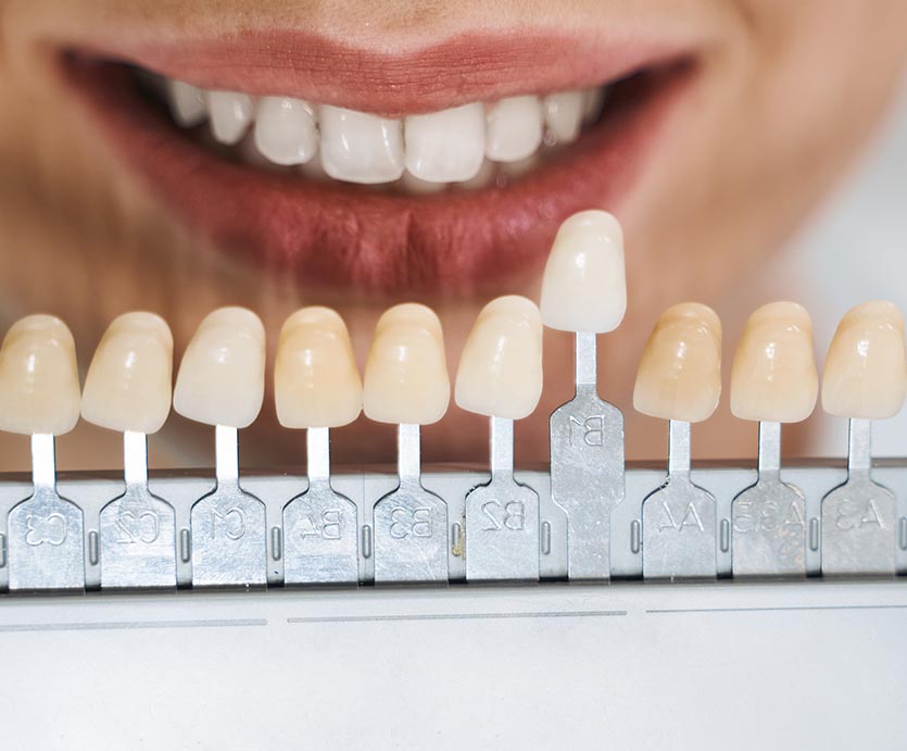 Dental Veneers - Mint Leaf Dental Clinic in Markham
